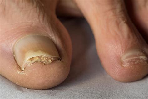 Fungal nail infection | nidirect