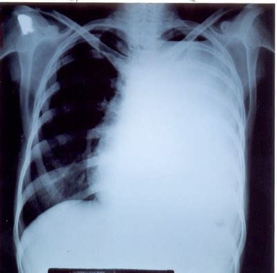 My Nurses Notes: Hydropneumothorax