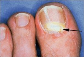 Treating Onychomycosis | AAFP