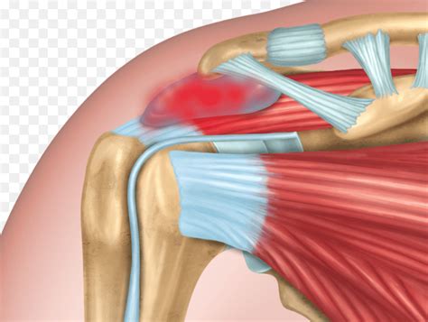 Shoulder Bursitis: A common cause of shoulder pain: Orthopedic Center for Sports Medicine ...