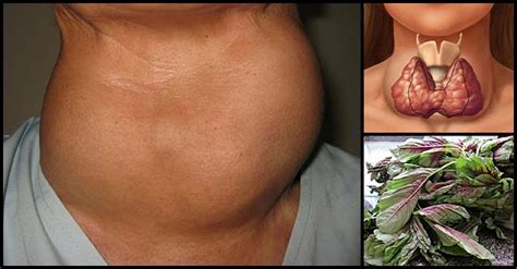 Common Remedies And Natural Ways That May Help Shrink Goiter - Dr. Farrah MD