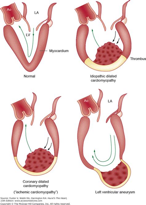 Lv Apical Aneurysm | semashow.com