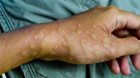 What Are Chronic Hives (Urticaria)? Causes and Treatment - GoodRx