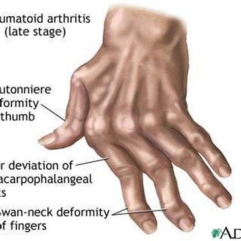 Stages of Rheumatoid Arthritis | Healthy Living