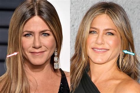 Jennifer Aniston Plastic Surgery: Before and After Pictures