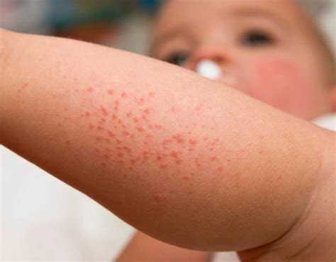 Skin Rashes In Children