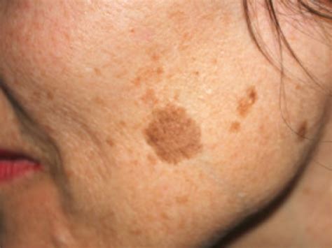 Age Liver Spots: Symptoms, Causes, Treatment Toronto Dermatology Centre | atelier-yuwa.ciao.jp