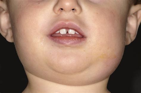 Submandibular Gland Swelling In Children