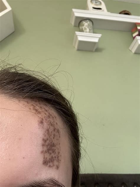 Birthmark Type ID please! : r/Birthmark