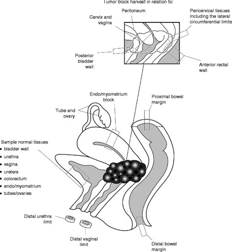 Pelvic Exenteration Specimens | SpringerLink