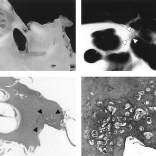 Prevalence of histologic otosclerosis in the Caucasian population ...