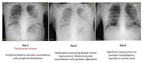 Chest xraybefore (day 4) and after (day 6 and 8) tocilizumab infusion ...