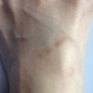 Scar Treatment for Raised and Discolored Scars - Just About Skin