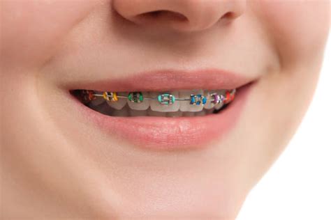 2,100+ Ceramic Braces Stock Photos, Pictures & Royalty-Free Images - iStock