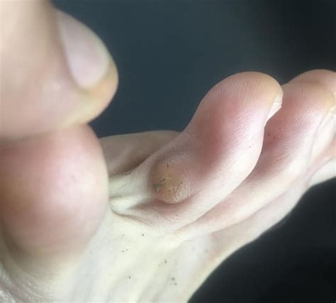 I have a bony lump on my big toe, does anyone know what this is? : Podiatry