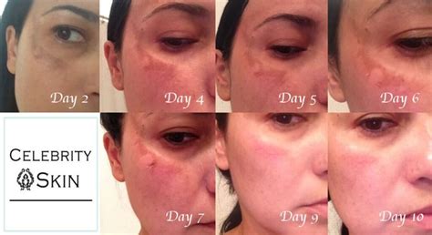 Are Chemical Peels Worth The Hype? Your Skins New Best Friend! - Vườn Bưởi Tư Trung