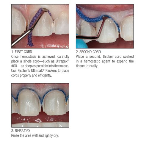 Mastering Retraction Cord Placement