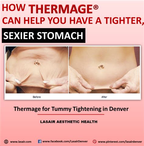 Thermage for Tummy Tightening in Denver | Skin tightening stomach ...