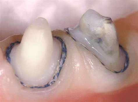 Gingival Retraction Methods and materials used | JuniorDentist.com