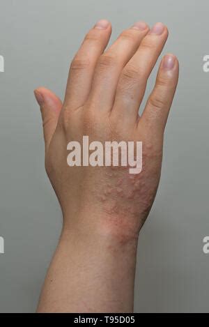 Shingles (Herpes Zoster) rash on hand Stock Photo - Alamy