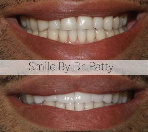 Before & After Photos | Dr. Patty Cosmetic Dentistry | FL 33304