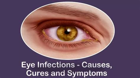 PPT - Eye Infections - Causes, Cures and Symptoms PowerPoint ...