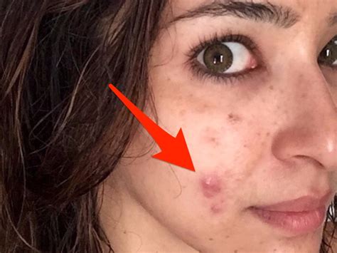 A Dermatologist Shared Photos of Her Cystic Acne on Instagram - Business Insider