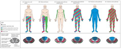 Central Cord Syndrome - Symptoms, Treatment, Prognosis, ICD 10