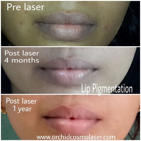 Before / After Images of pigmentation treatment | Orchid Cosmo laser