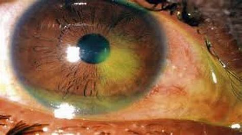 Corneal abrasion: Causes, Symptoms, Diagnosis & Treatments