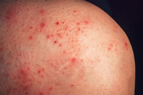 Does Stress Cause Petechiae? | LoveToKnow Health & Wellness