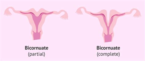 Partial vs. complete bicornuate uterus