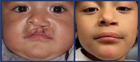 Cleft Lip Surgery Before And After