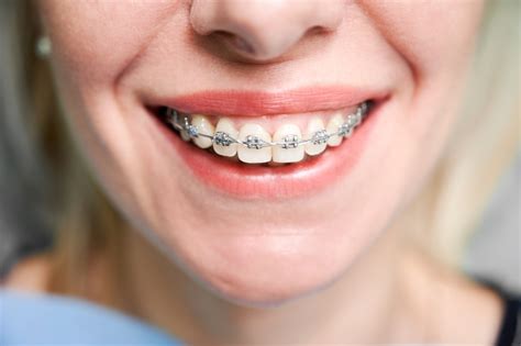 How Long Do Braces Hurt? | The Orthodontic Place