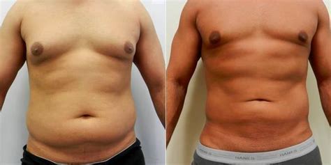 Truth Or Fact Behind Vaser Lipo Recovery