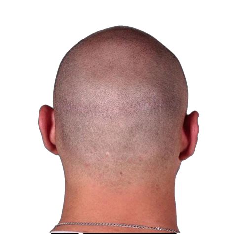 Scar Micropigmentation Camouflage & Hair Tattoo Balding