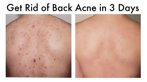 How You Can Put A Stop To Acne - Health and Skin Care | Chest acne ...