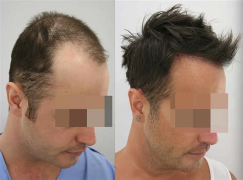 15+ Hair Transplant Cost Dallas - KaeleyKailum