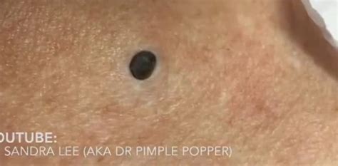 Dr. Pimple Popper -- The Biggest Blackhead In History!