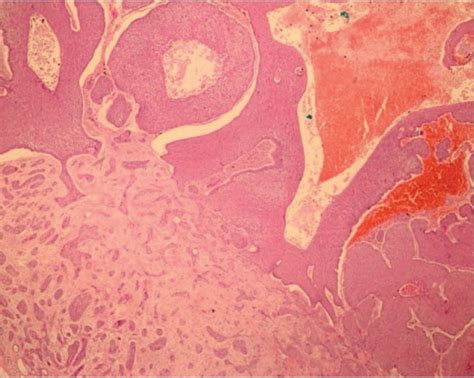 Giant Cornu Cutaneum Superimposed on Basal Cell Carcinoma. - Abstract ...