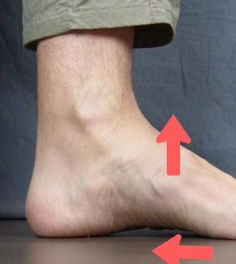 Hindfoot Valgus Symptoms, Causes, Exercises, Surgery