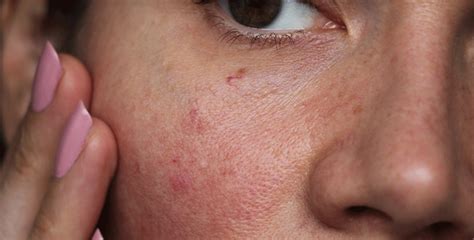 Why is My Skin so Sensitive? | Columbia Skin Clinic