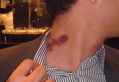 What Causes Hickeys