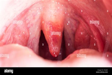 Red, inflamed and swollen uvula in the throat. Treatment of uvulitis due to bacteria and ...