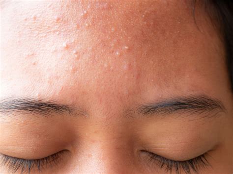 How to treat acne bumps on your forehead