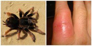 How to Identify a Spider Bite and Treat It | TruePrepper