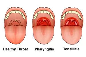 Stay Away from Pharyngitis & Tonsillitis - BiO-LiFE