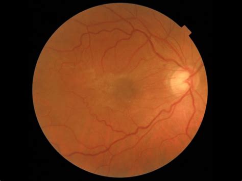 Epiretinal Membranes / Cellophane Maculopathy – Mr. Kirti M Jasani