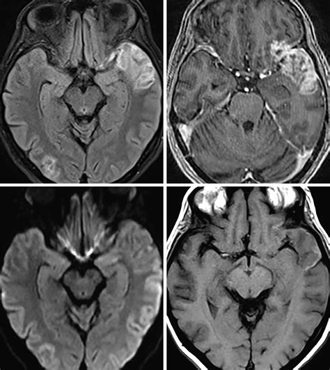 Subacute Infarction | The Neurosurgical Atlas