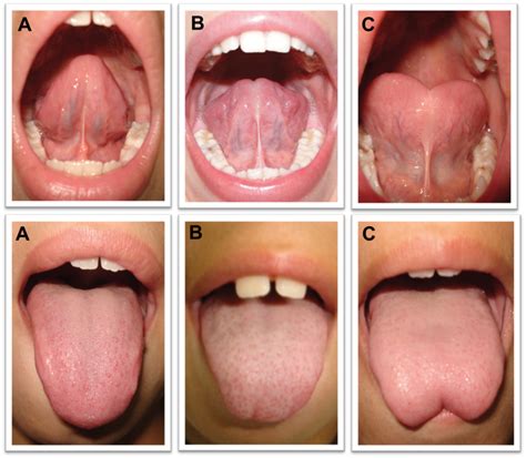 Frenulum Tongue